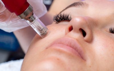 What is Micro-Needling? How Does It Improve My Skin’s Health?